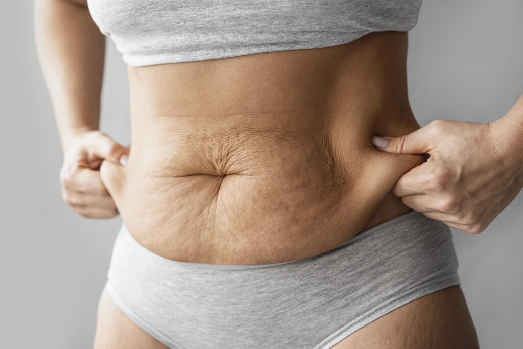 Combate à Flacidez na barriga: Causas e Tratamentos Eficazes